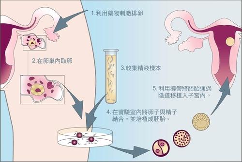 泰国试管婴儿是不孕不育患者的曙光，这将影响泰国试管婴儿的成功率